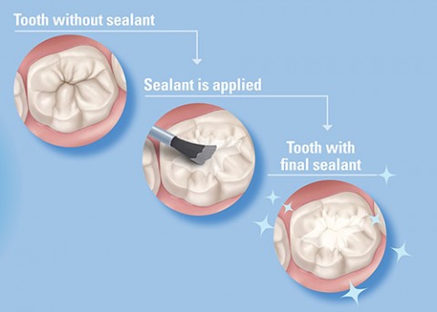 dental-sealants