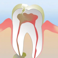 Abscessed Tooth