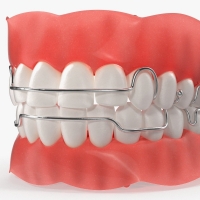 Orthodontic Retainer