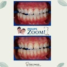 Philips Zoom In Office Whitening