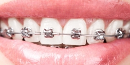Traditional Metal Wire Braces 2018-02-11