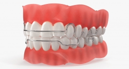 orthodontic retainer